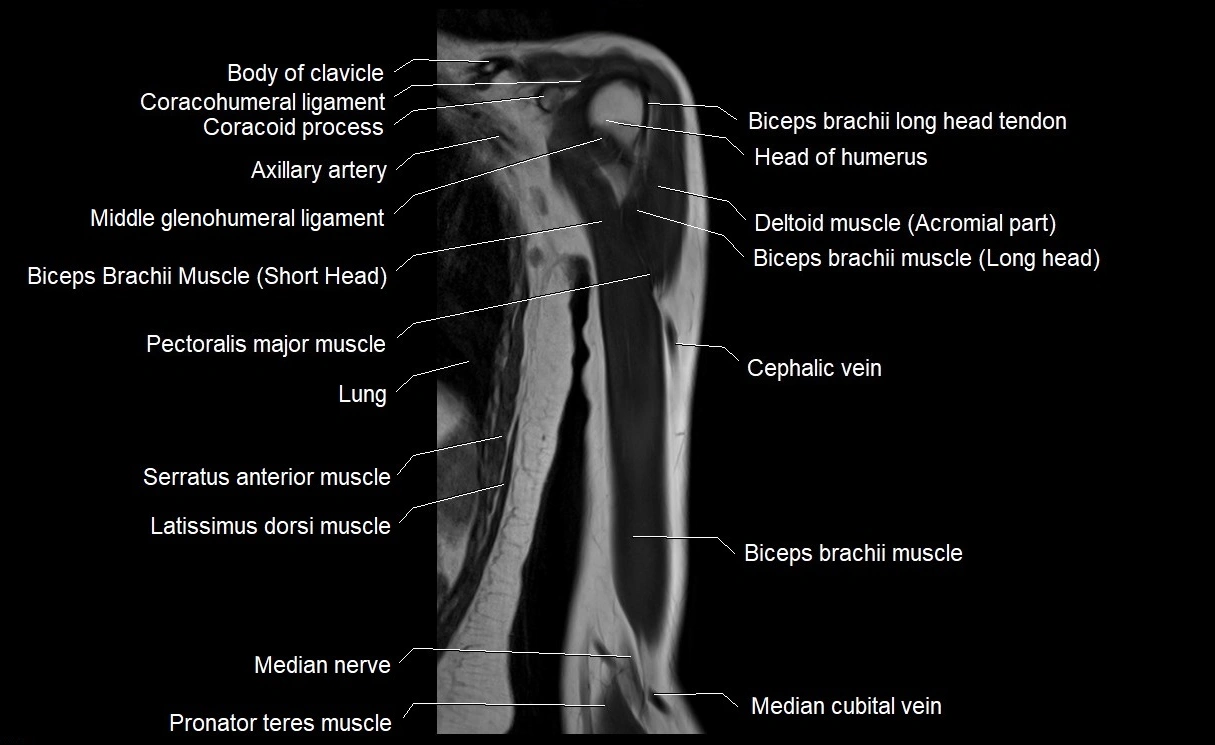 MRI upper arm (humerus ) coronal cross sectional anatomy image 7.webp